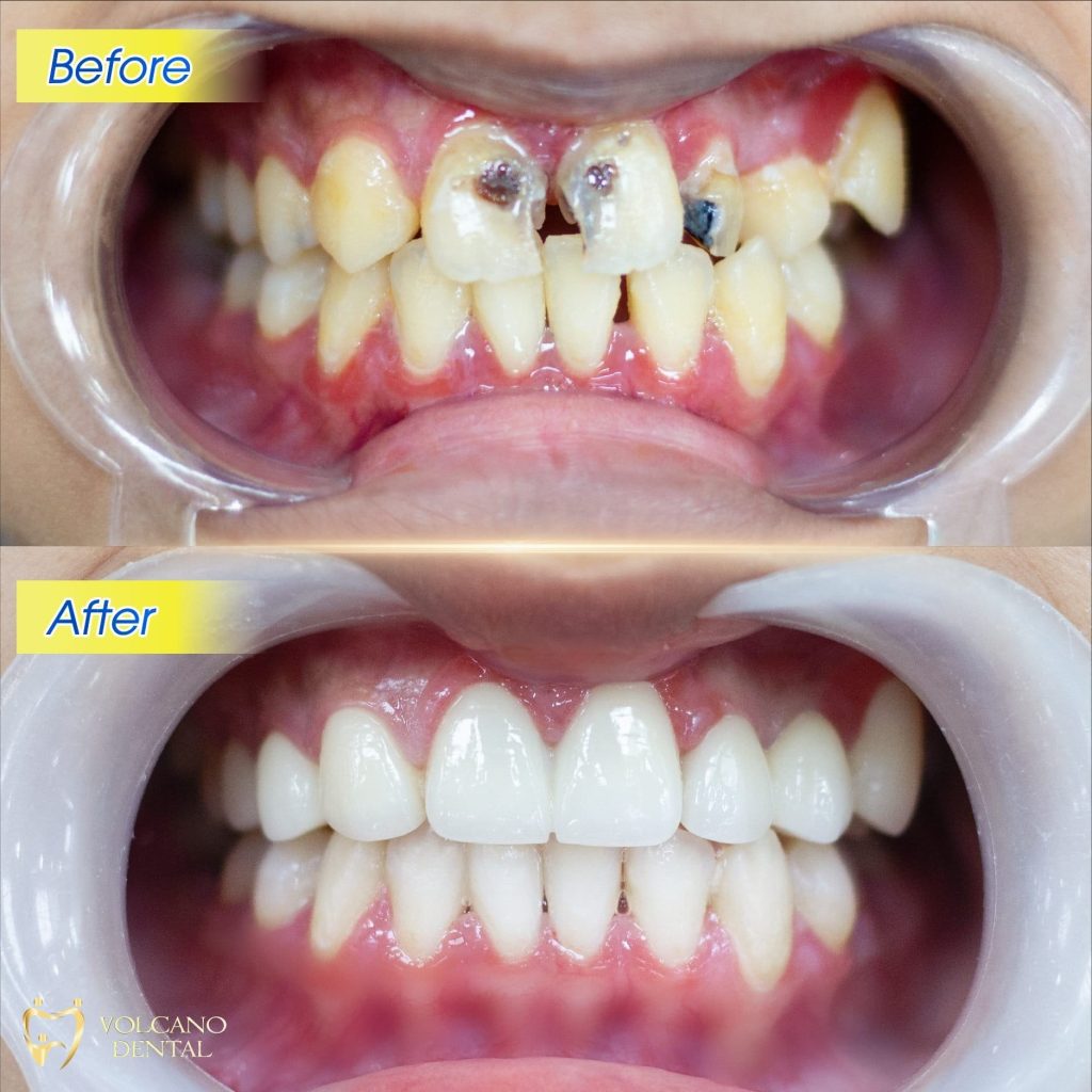Phục hình răng sứ
